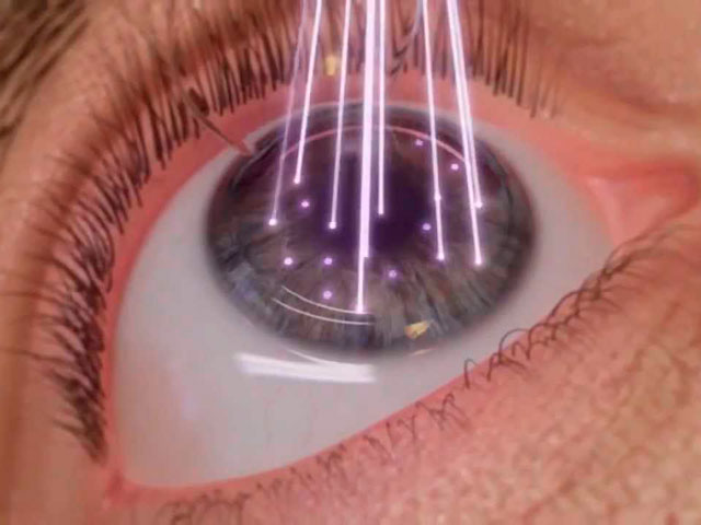 операция по коррекции зрения 